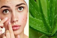 Rawatan Jerawat Dengan Lidah Buaya – Cara dan Tips