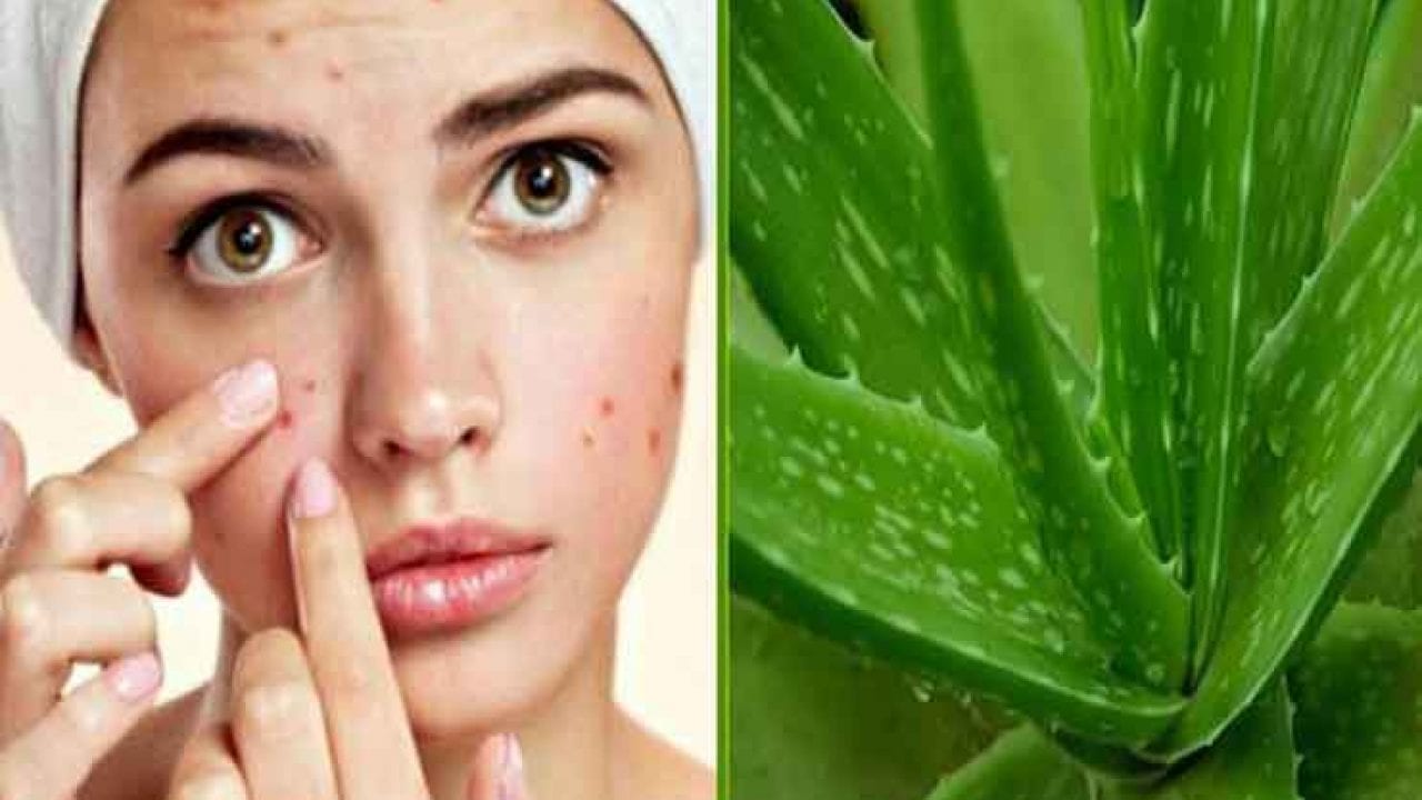 Rawatan Jerawat Dengan Lidah Buaya – Cara dan Tips